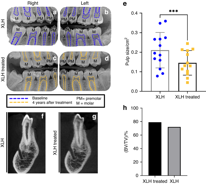 Dental impact of anti-fibroblast growth factor 23 therapy in X-linked hypophosphatemia