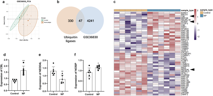 E3 ubiquitin ligase NEDD4L inhibits epithelial-mesenchymal transition by suppressing the β-catenin/HIF-1α positive feedback loop in chronic rhinosinusitis with nasal polyps