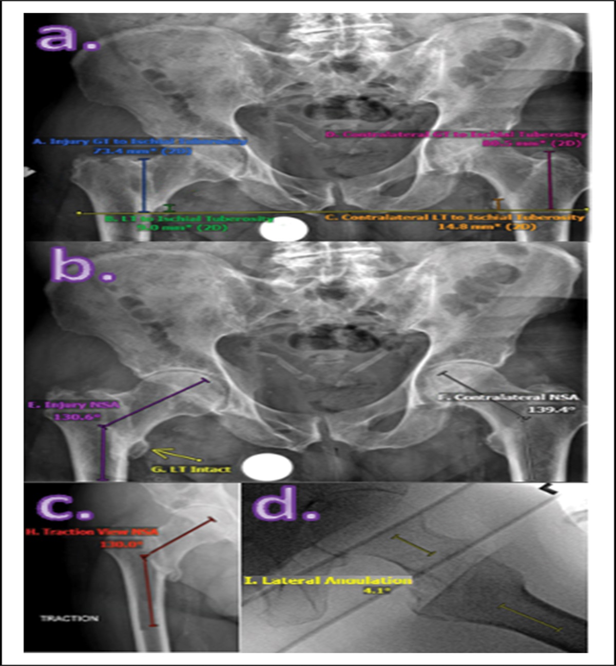 A Good Tip-Apex Distance Does Not Make Up For a Poor Reduction in Intertrochanteric Hip Fractures Treated with an Cephalomedullary Nail: The Utility of the Neck-Shaft Angle in Preventing Fixation Failure