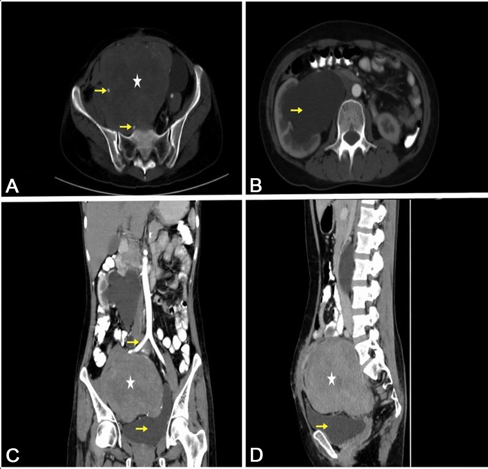 En Bloc Resection of Common Iliac Artery, Iliac Vein, Ureter Along with Broad Ligament Sarcoma and Reconstruction of External Iliac Artery