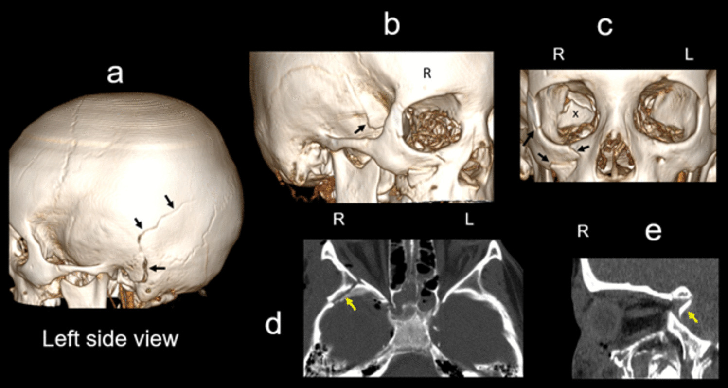 Moving it Forward: a Twenty-First Century Approach to Pediatric Neuropsychological Evaluation and the Importance of Integrating Neuroimaging Findings