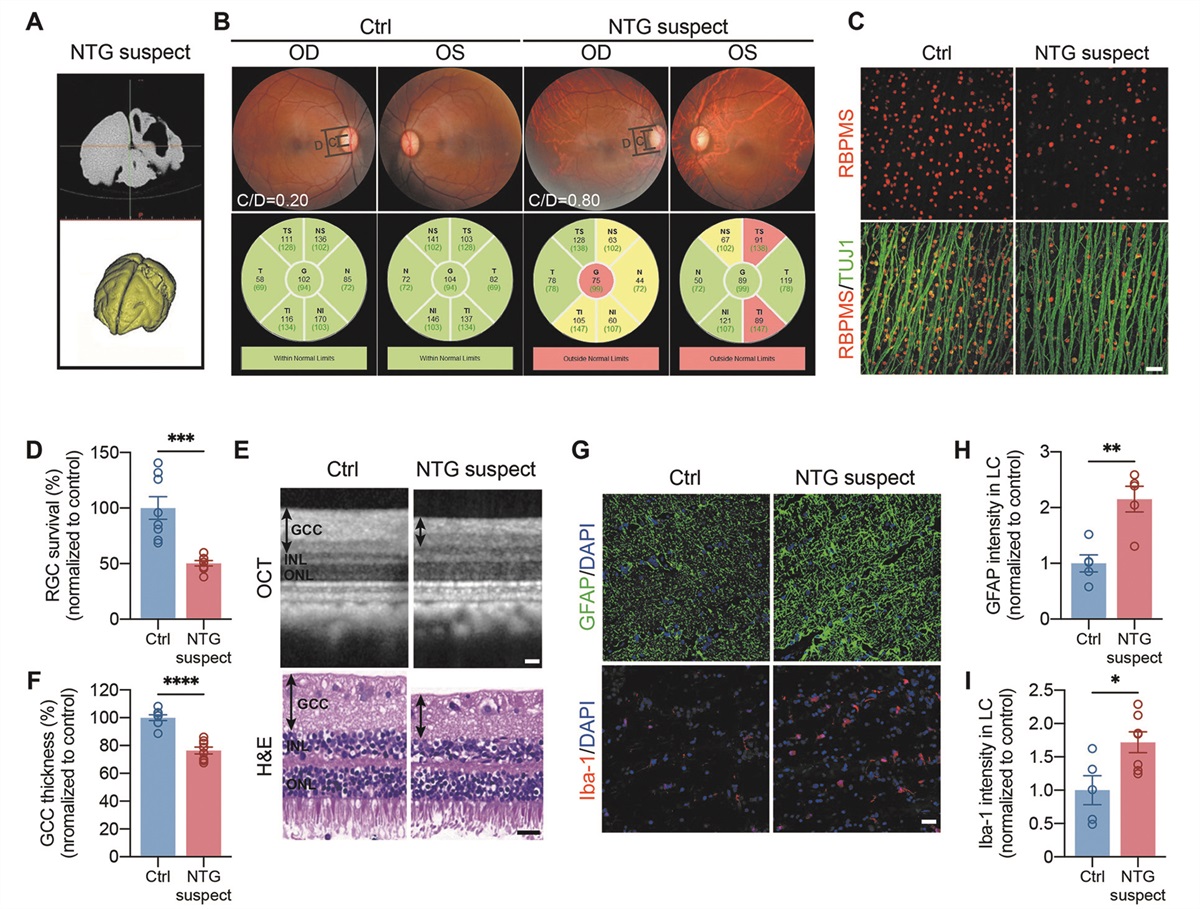 Discovery of a normal-tension glaucoma-suspect rhesus macaque with craniocerebral injury: Hints of elevated translaminar cribrosa pressure difference