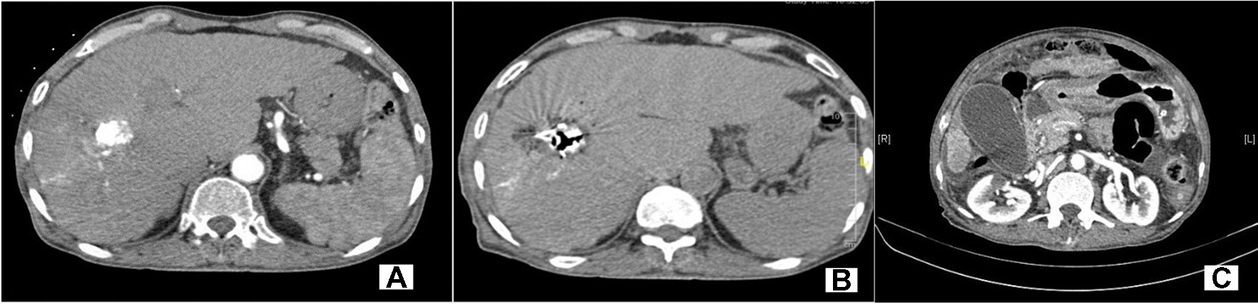 Post-transarterial chemoembolization lipiodol migration with obstructive biliopathy