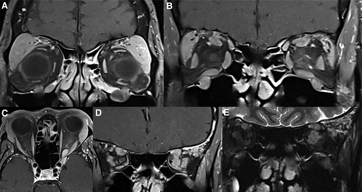 IgG4-related Orbital Disease Presenting as an Orbital Apex Lesion