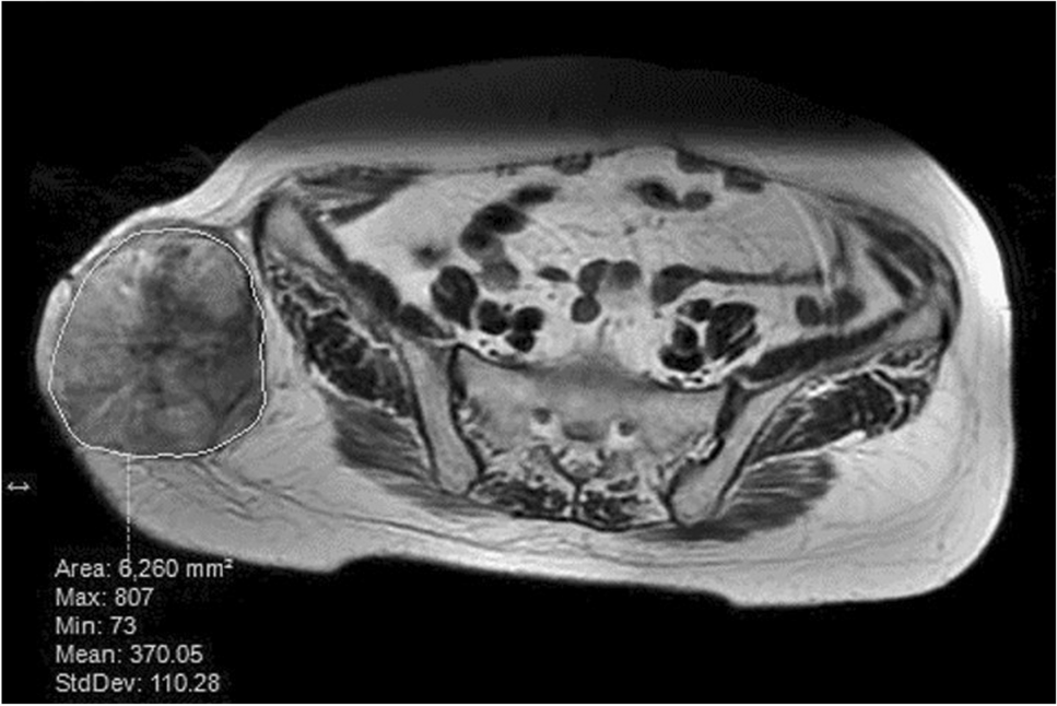 Coefficient of variation of T2-weighted MRI may predict the prognosis of malignant peripheral nerve sheath tumor