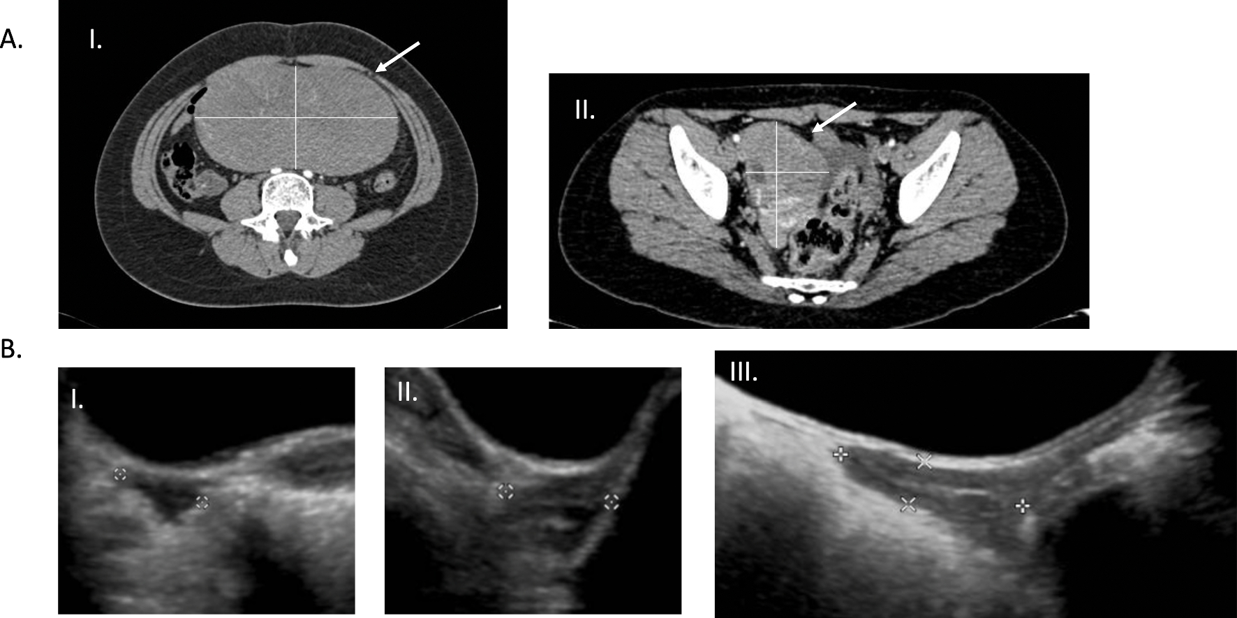 Dysgerminoma Probably Due to a Novel SOHLH1-pathogenic Variant Causing Familial Ovarian Dysgenesis