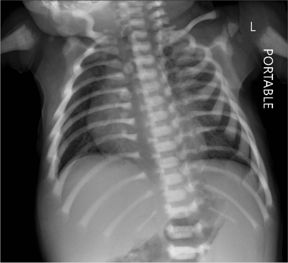 Osteopetrorickets: two contradictory patterns—one unifying diagnosis