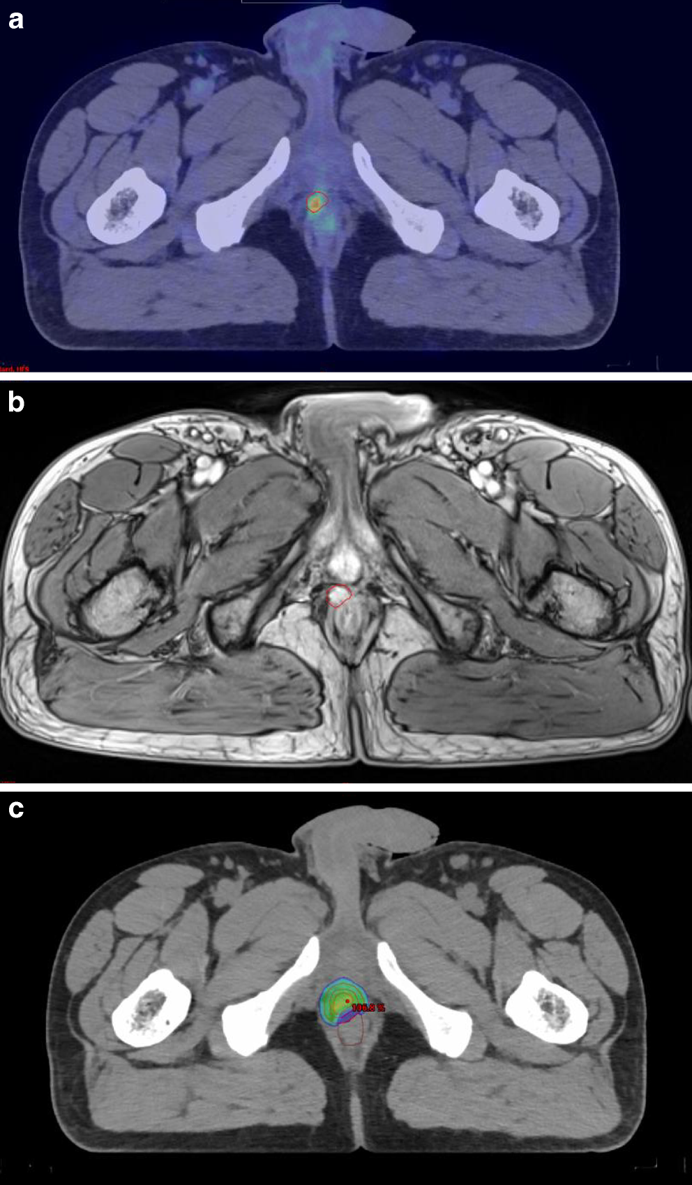 Stereotactic body radiotherapy (SBRT) re-irradiation for local failures following radical prostatectomy and post-operative radiotherapy