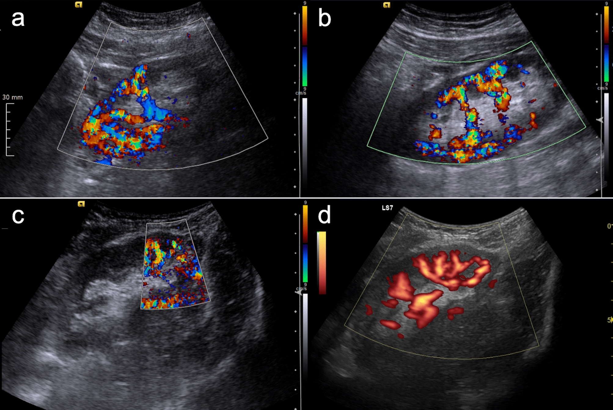 Retrospective analysis of the perioperative outcome in living donor kidney transplantation with multiple renal arteries: does accessory vessel ligation affect the outcome?