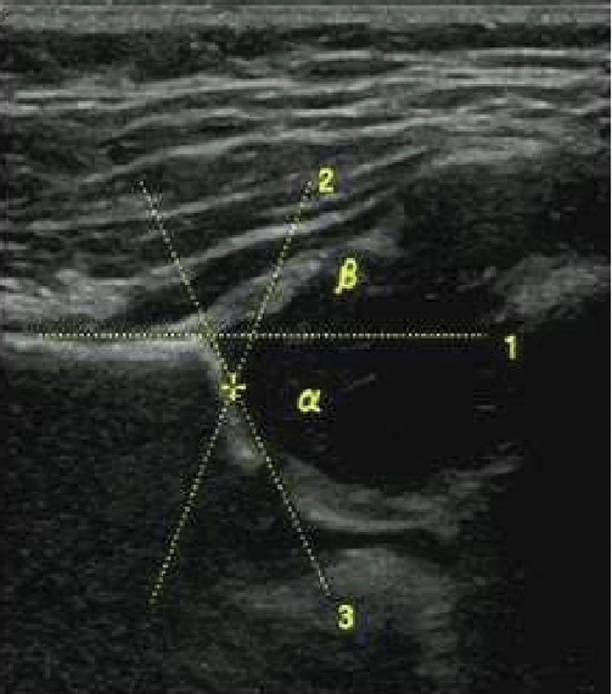 The outcome of early screening and treatment of developmental dysplasia of the hip in infants and toddlers in the Northern Guizhou region