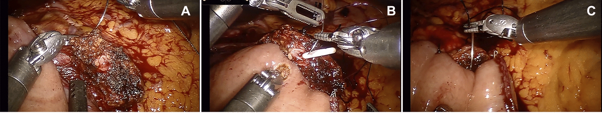 The development of a deep learning model for automated segmentation of the robotic pancreaticojejunostomy