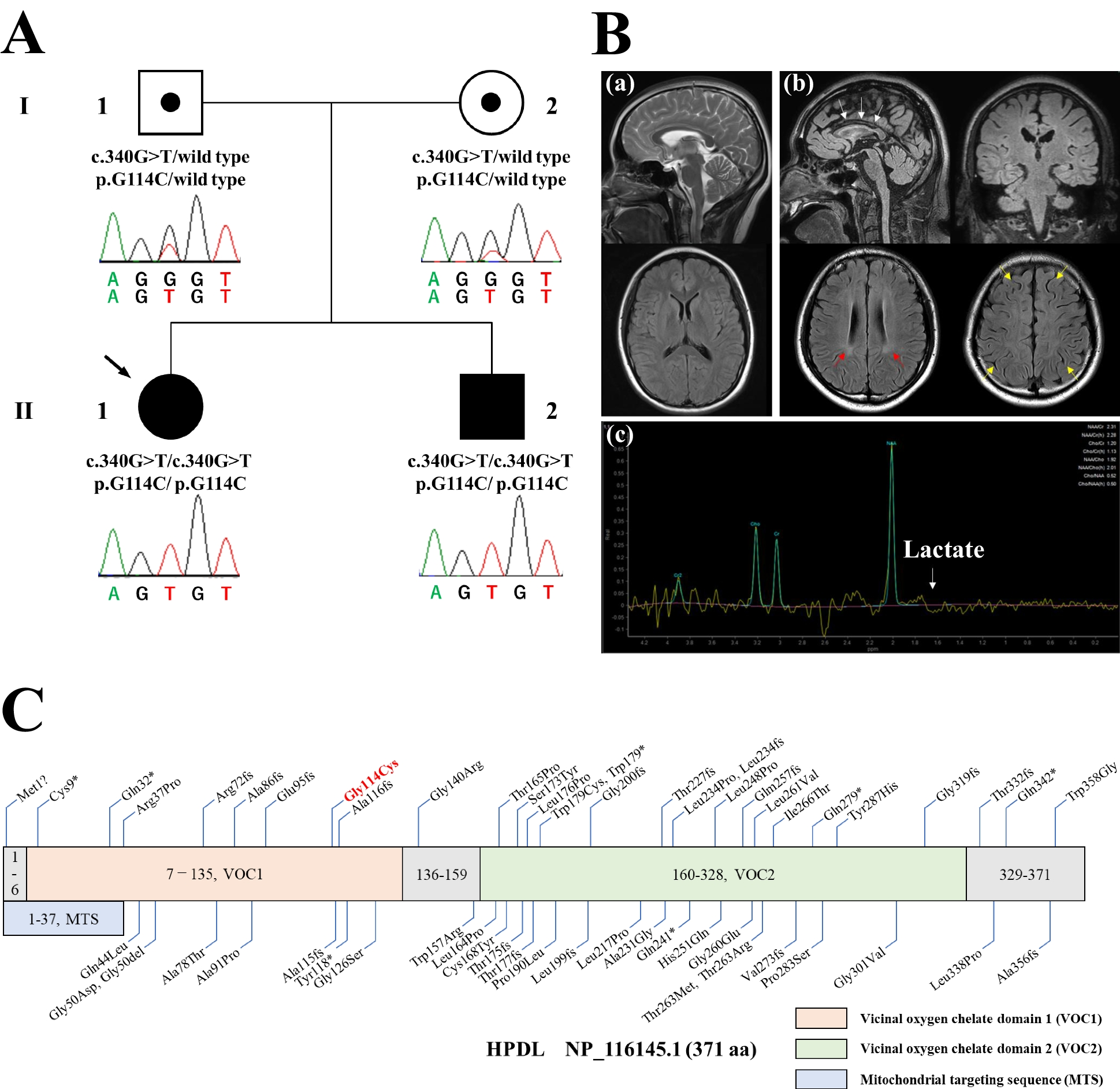 A novel homozygous HPDL variant in Japanese siblings with autosomal recessive hereditary spastic paraplegia: case report and literature review