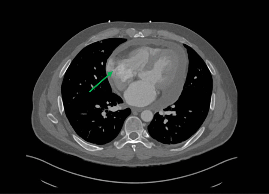 Unusual presentation and delayed diagnosis of cardiac angiosarcoma