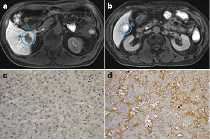 New understanding of hepatobiliary MRI