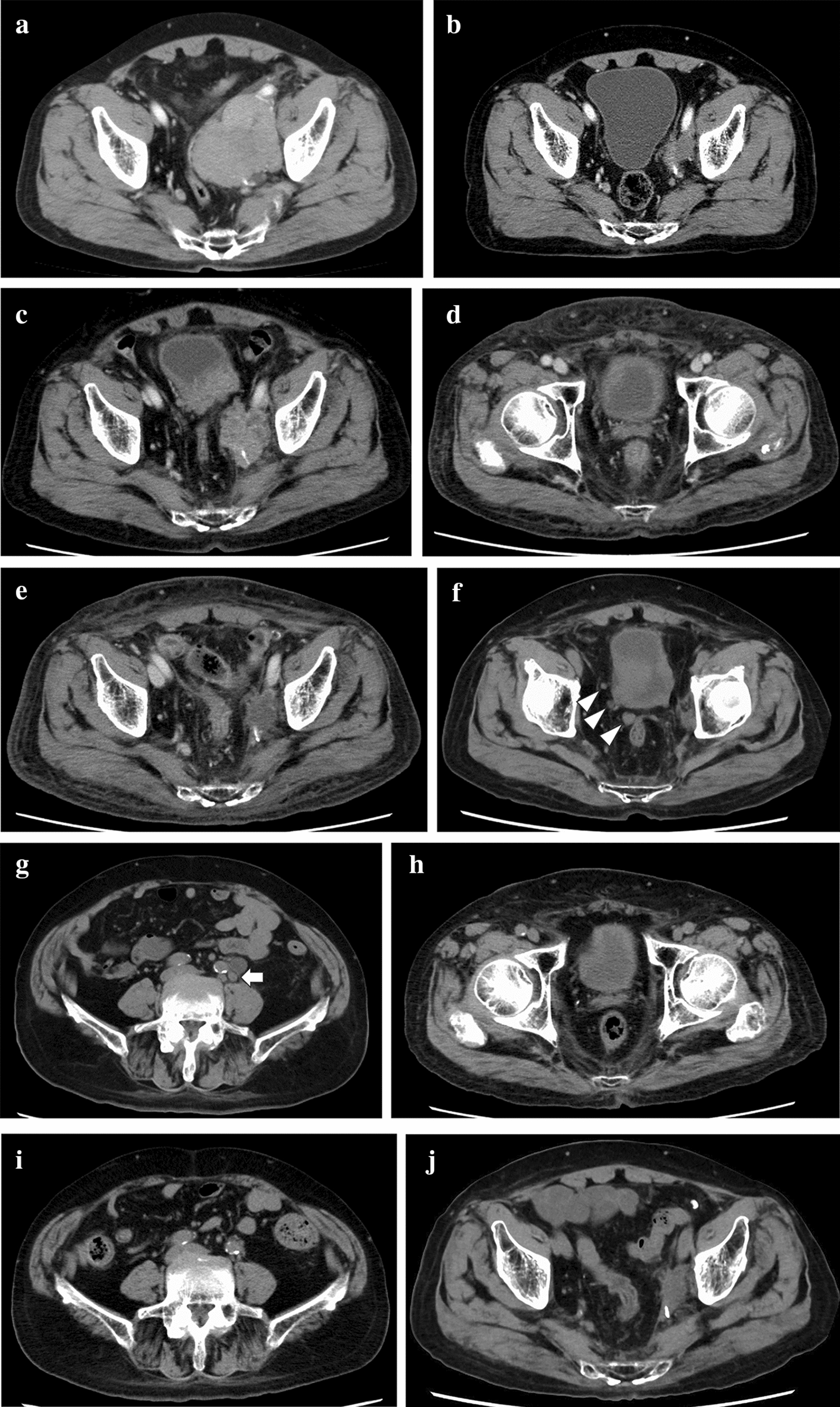 Significant reduction in burden of metastatic disease by intermittent docetaxel therapy in a patient with castration-resistant prostate cancer