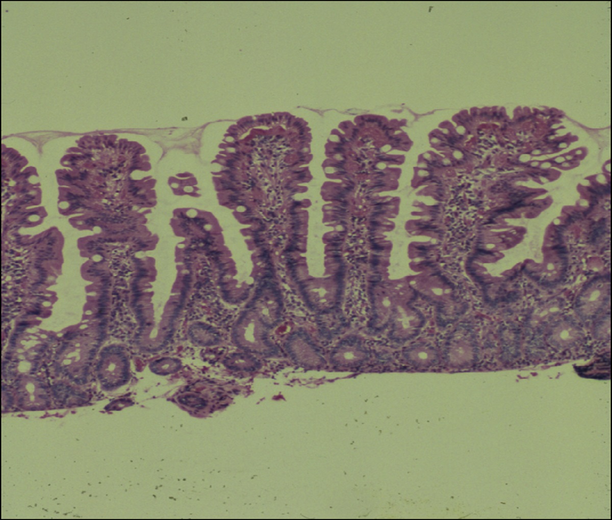 Fulminant Celiac Disease Presenting in the Postpartum Period