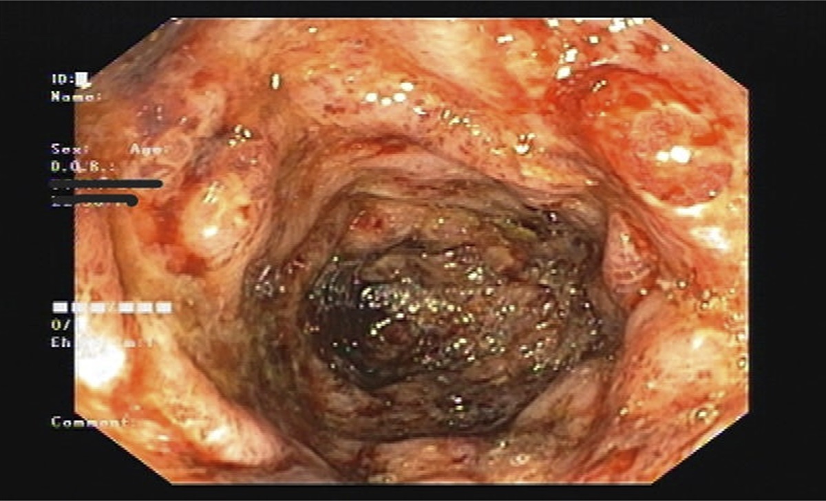 Nicorandil-Induced Acute Colitis