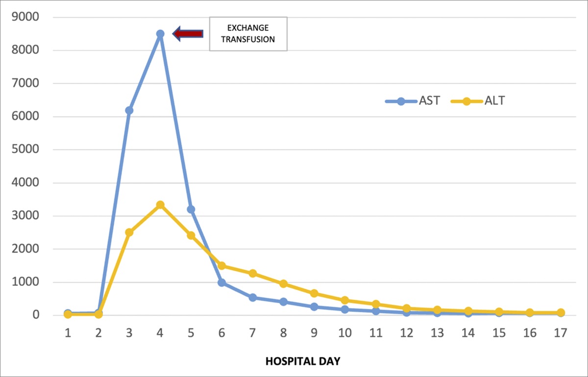 Acute Liver Failure With Liver Enzymes >5,000 in Sickle Cell Disease