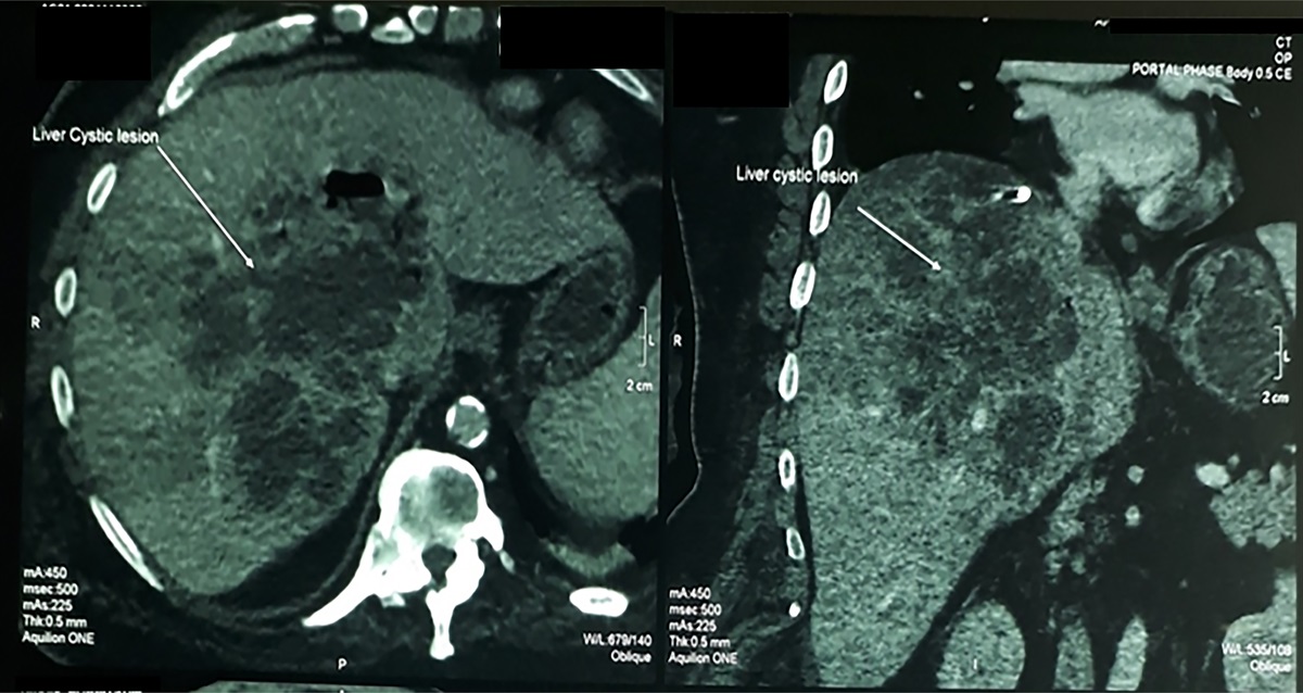 Liver Abscess Due to Migrated Foreign Body