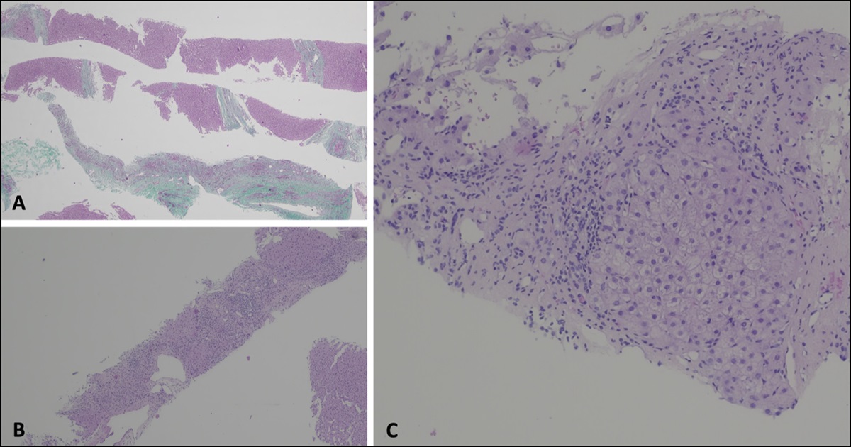 Autoimmune Hepatitis on a Living Liver Donor: An Unexpected Long-Term Complication