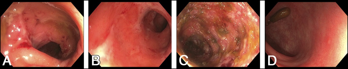 Vancomycin and Ustekinumab Combination Therapy in Acute Ulcerative Colitis