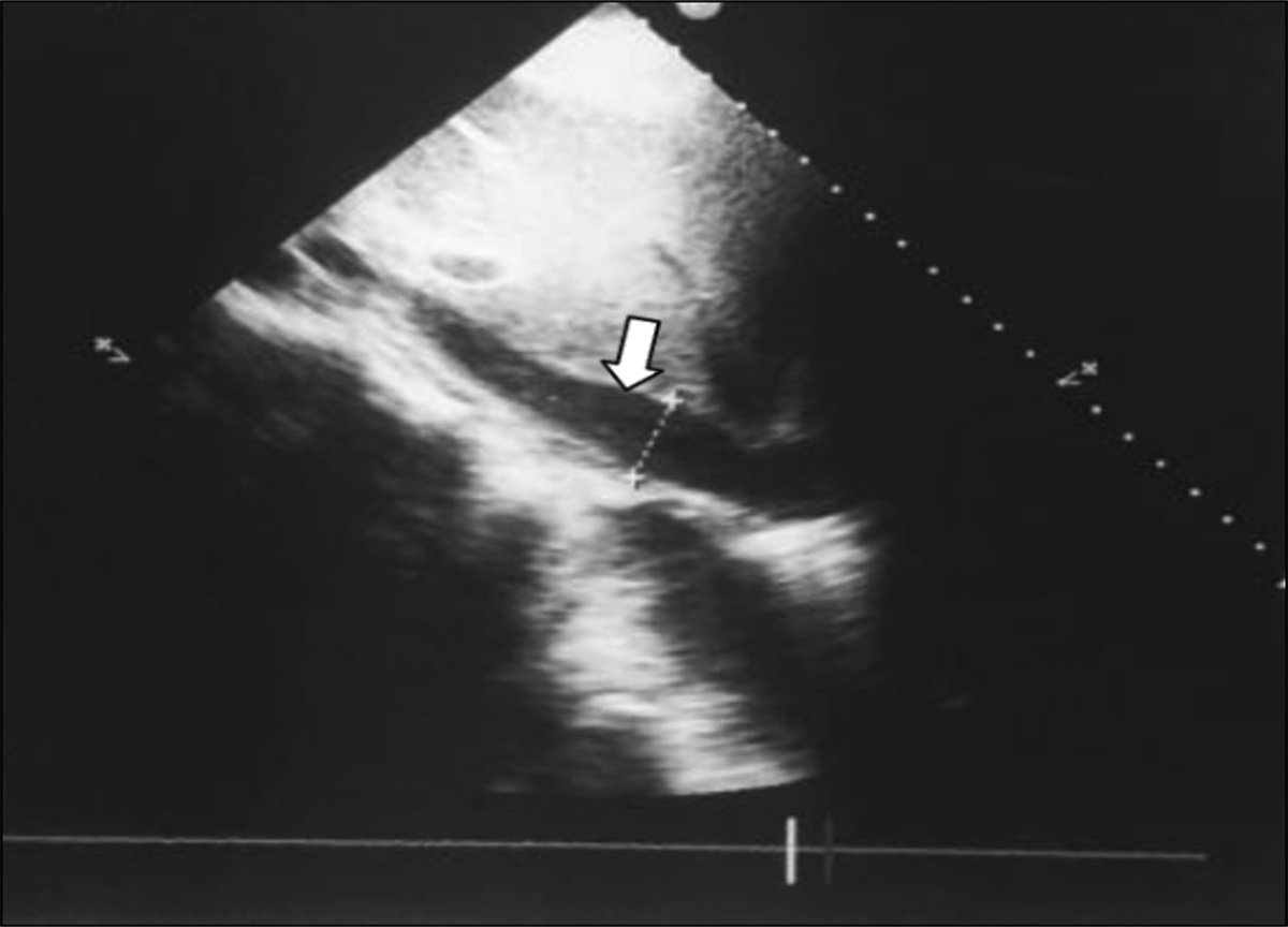 Esophageal Perforation by Fish Bone Ingestion Causing Purulent Pericarditis