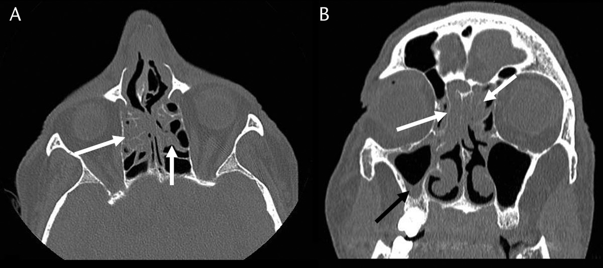 Acute Optic Nerve Ischemia in a Diabetic Patient