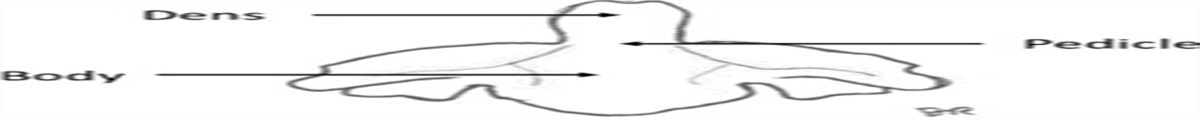 Odontoid/Dens Fractures