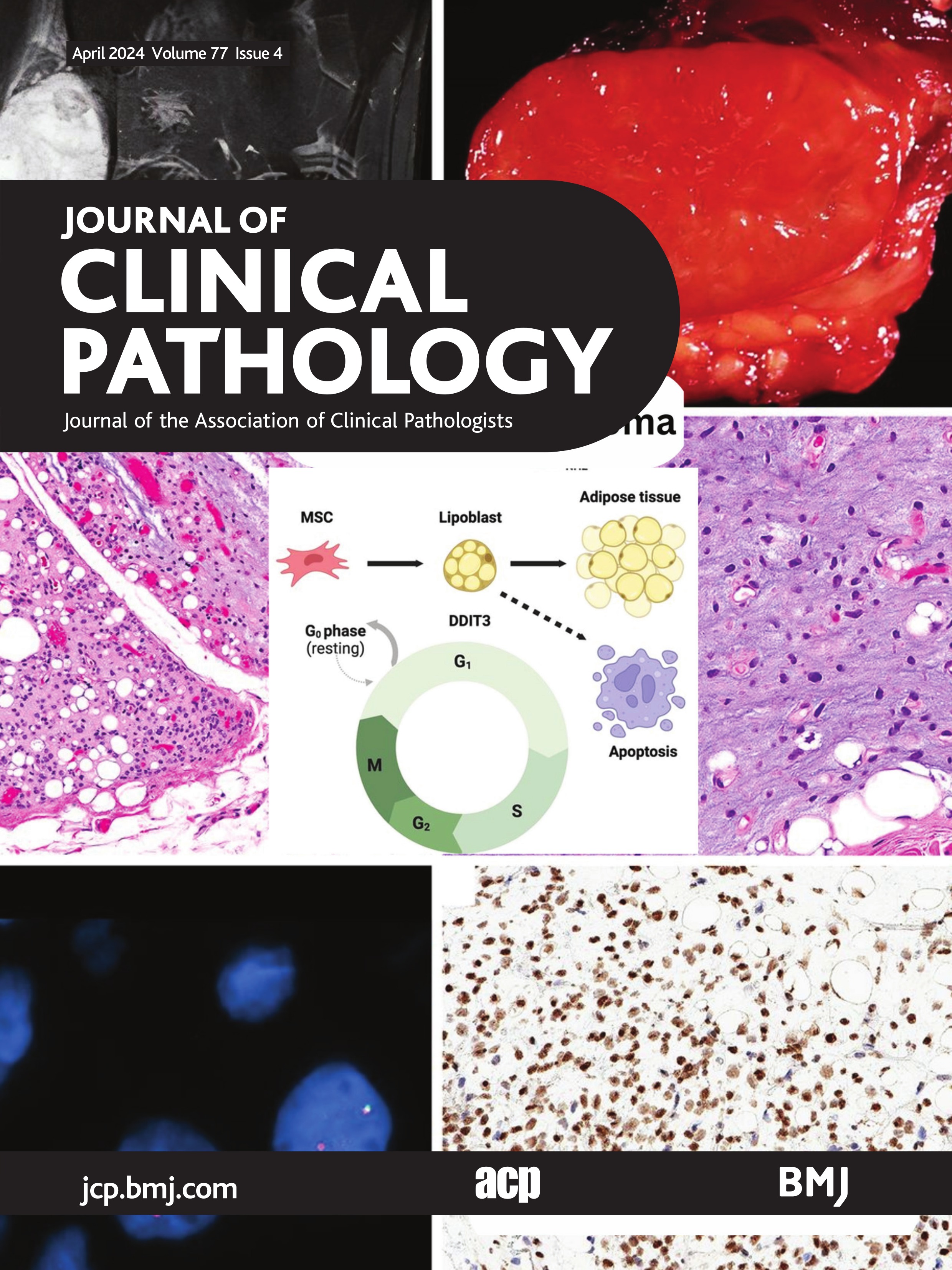 Impact of cellular morphology and three-tiered nuclear grade on progression of conventional renal cell carcinoma