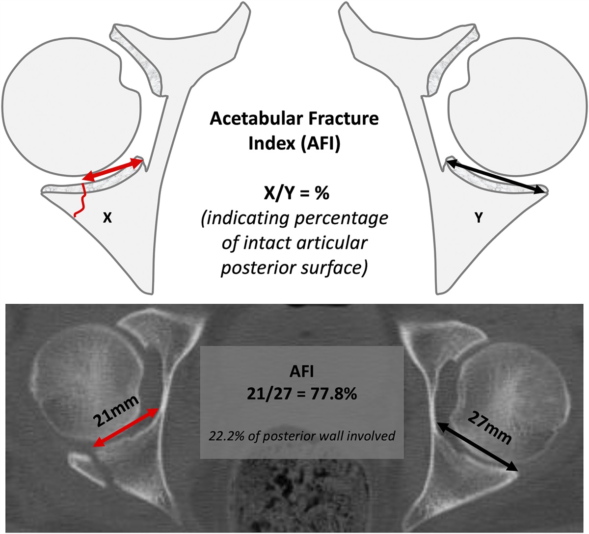 Femoroacetabular Variations Are Predisposing Factors for Traumatic Posterior Hip Dislocation