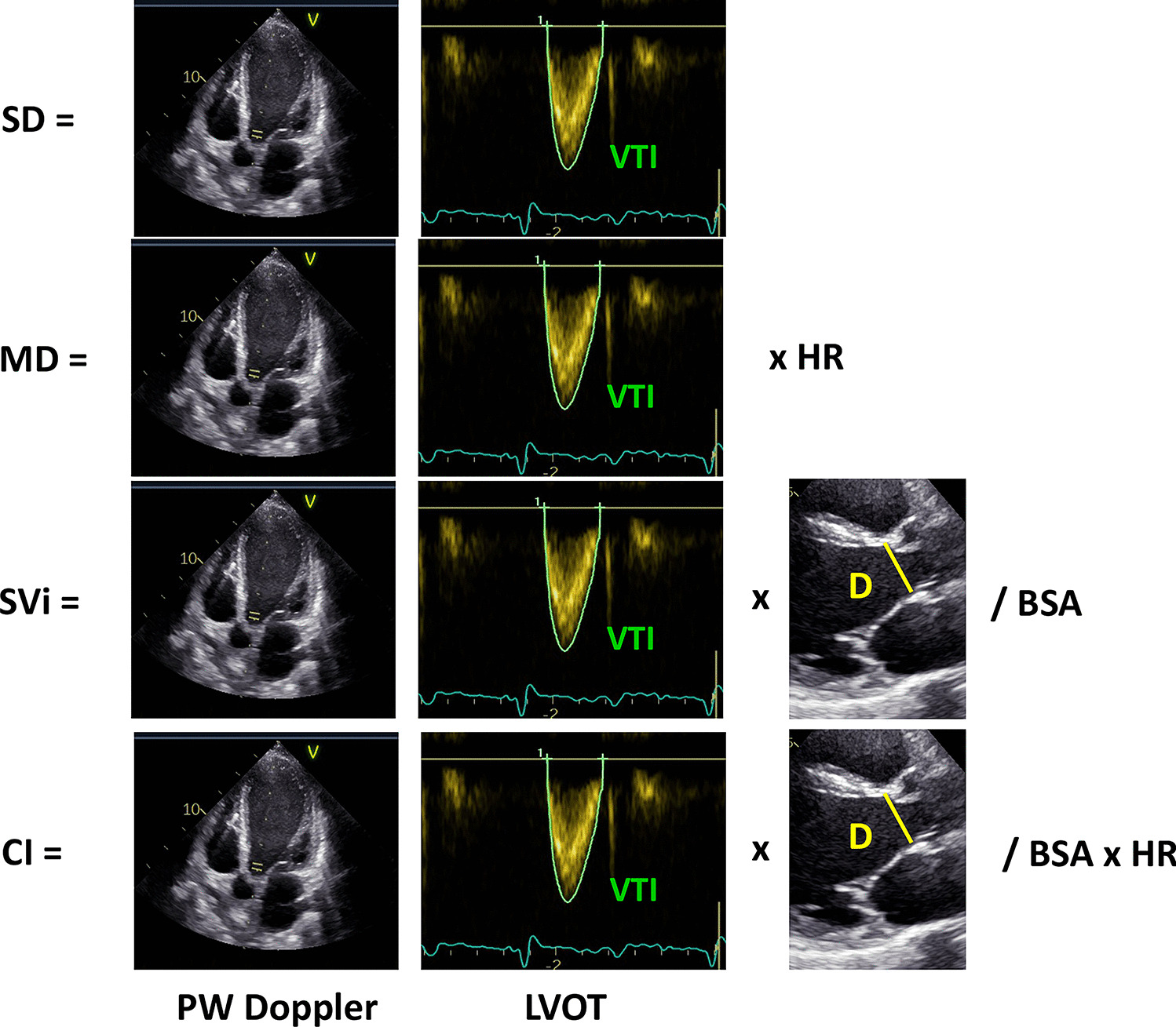 New perspectives in the echocardiographic hemodynamics multiparametric assessment of patients with heart failure