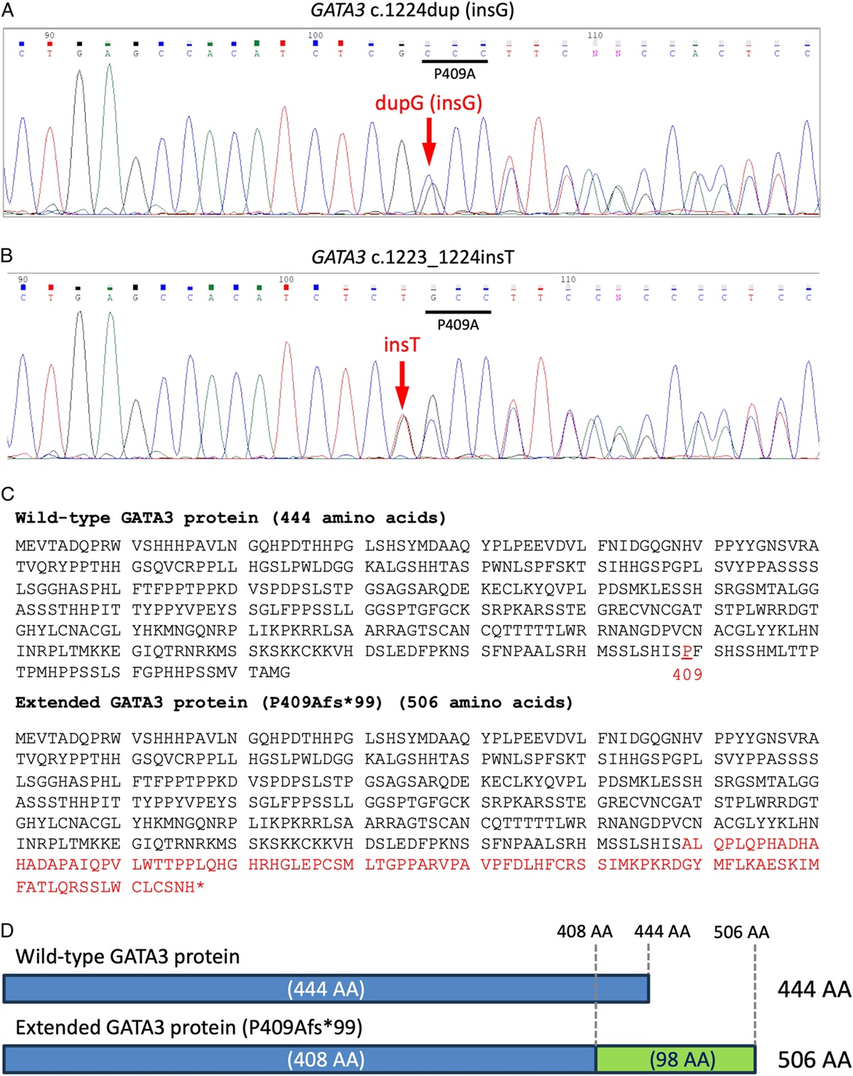 Recurrent GATA3 P409Afs*99 Frameshift Extension Mutations in Sweat-gland Carcinoma With Neuroendocrine Differentiation