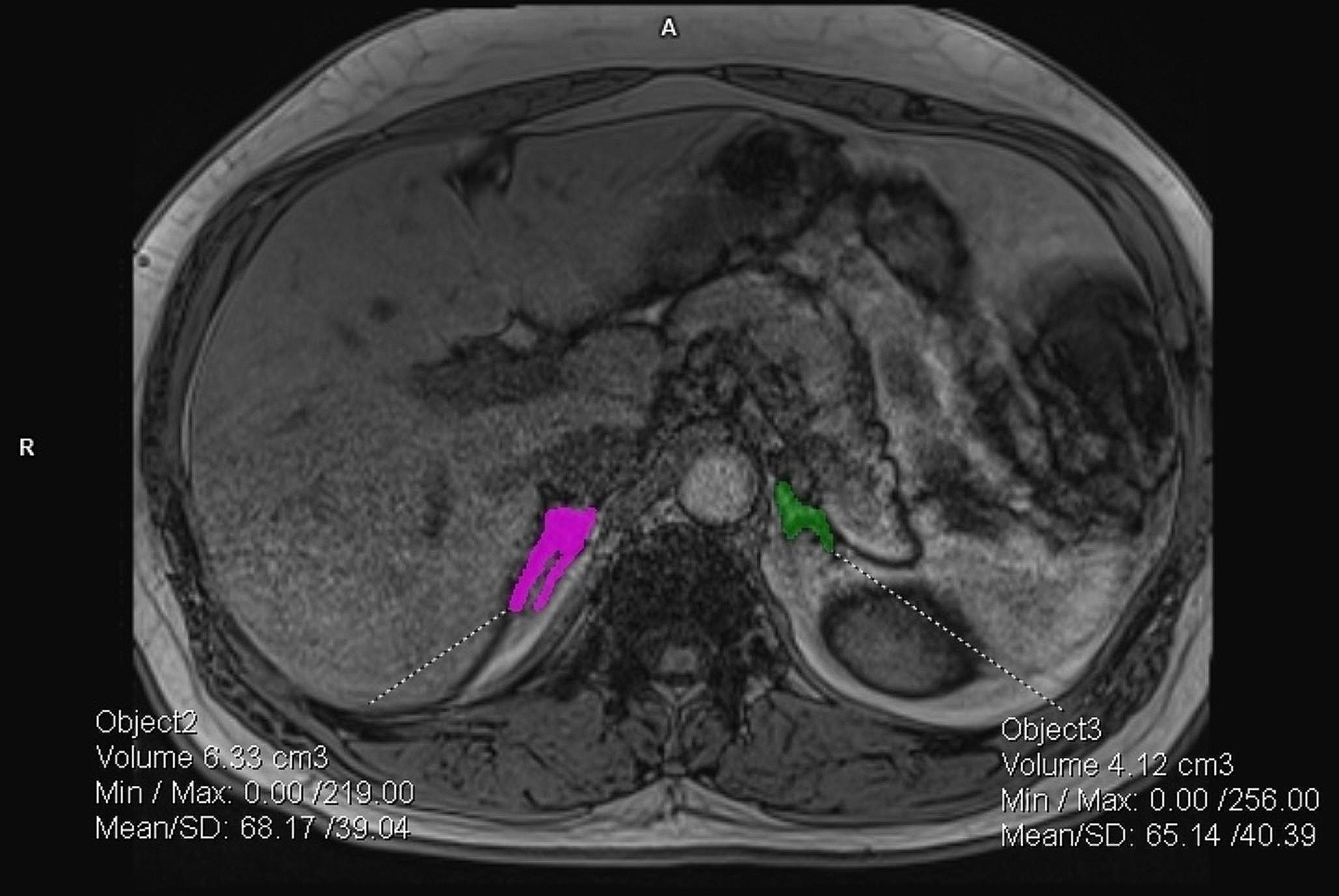 Clinical prediction model for primary aldosteronism subtyping and special focus on adrenal volumetric assessment