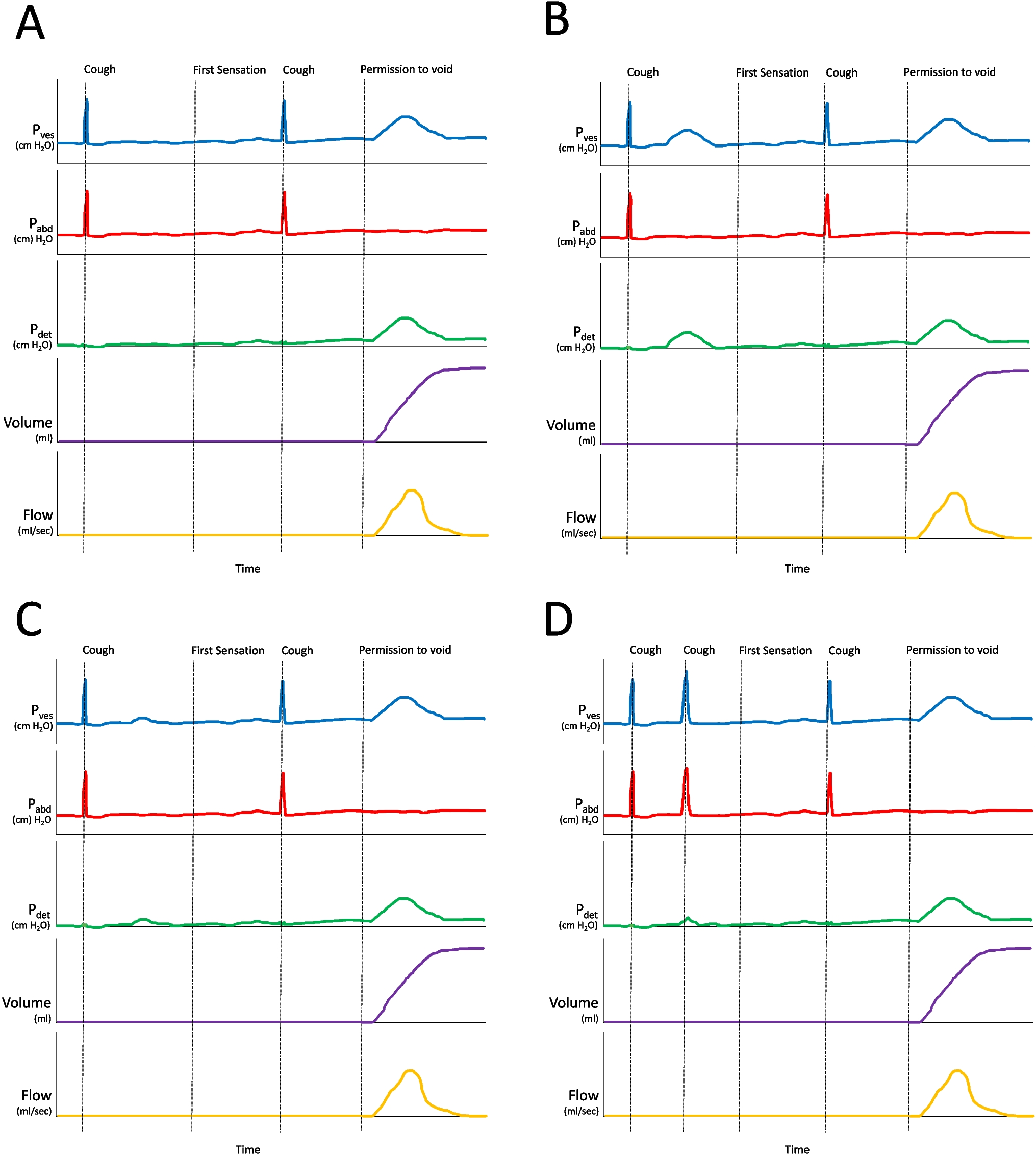 Machine Learning and Artificial Intelligence to Improve Interpretation of Urodynamics