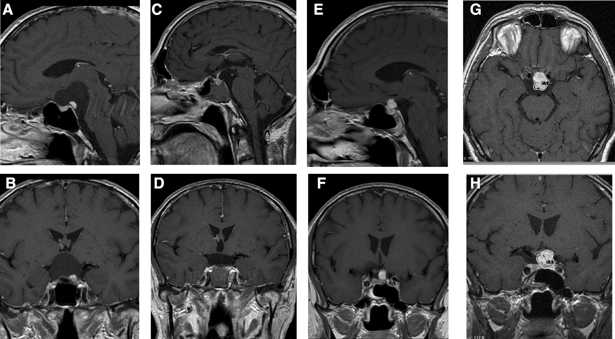 Targeted therapy in BRAF mutated aggressive papillary craniopharyngioma: a case report and overview of the literature