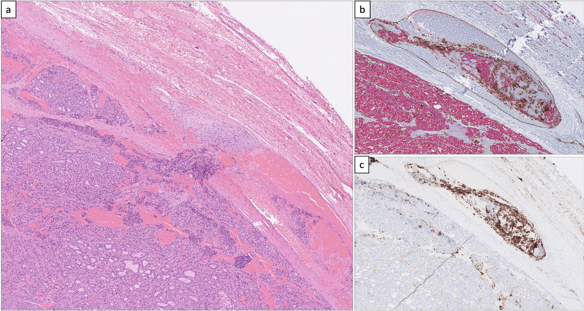 Spatial Transcriptomics in a Case of Follicular Thyroid Carcinoma Reveals Clone-Specific Dysregulation of Genes Regulating Extracellular Matrix in the Invading Front