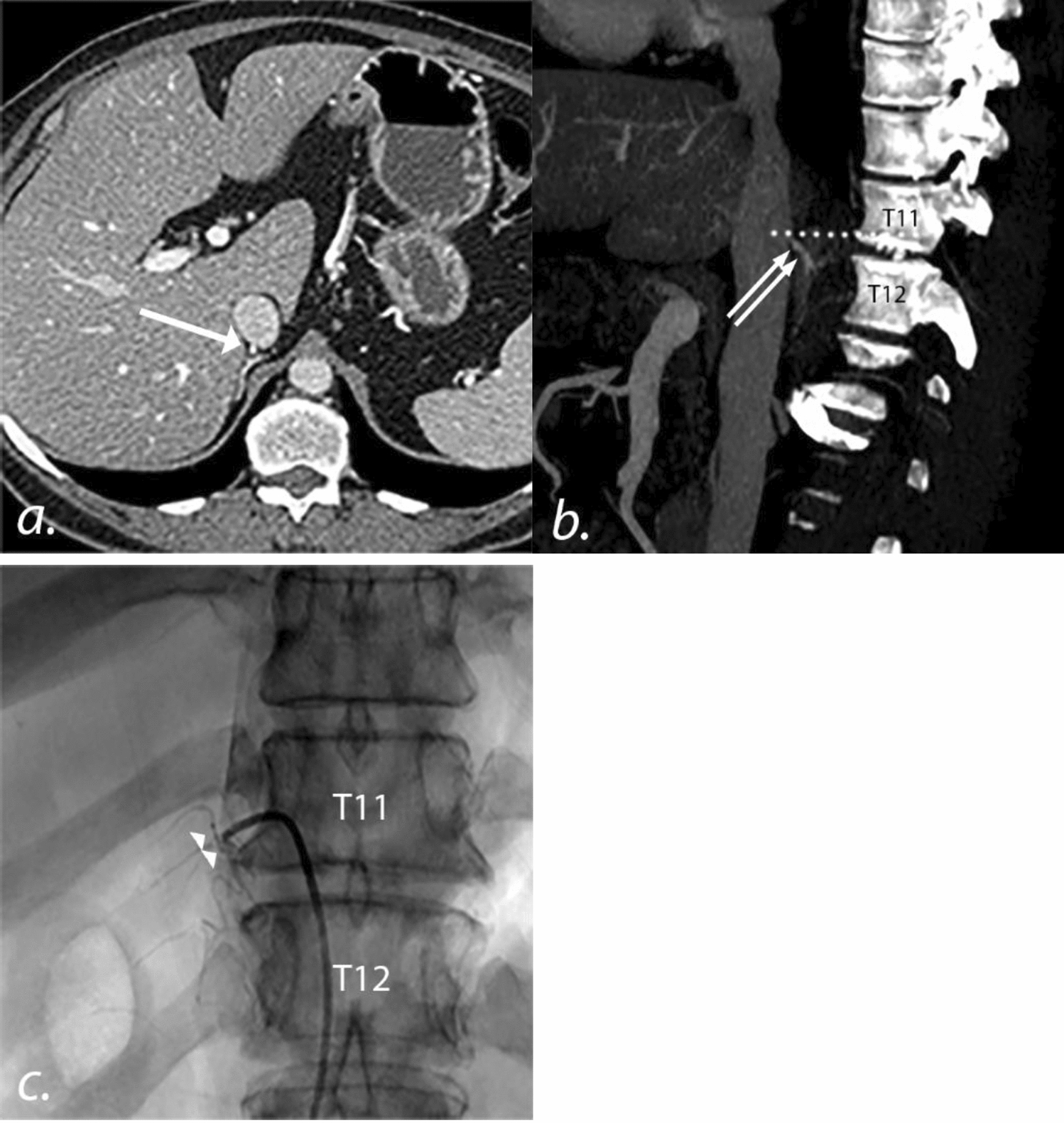 Pre-procedural and intra-procedural computerized tomography: providing a roadmap for successful adrenal venous sampling procedures