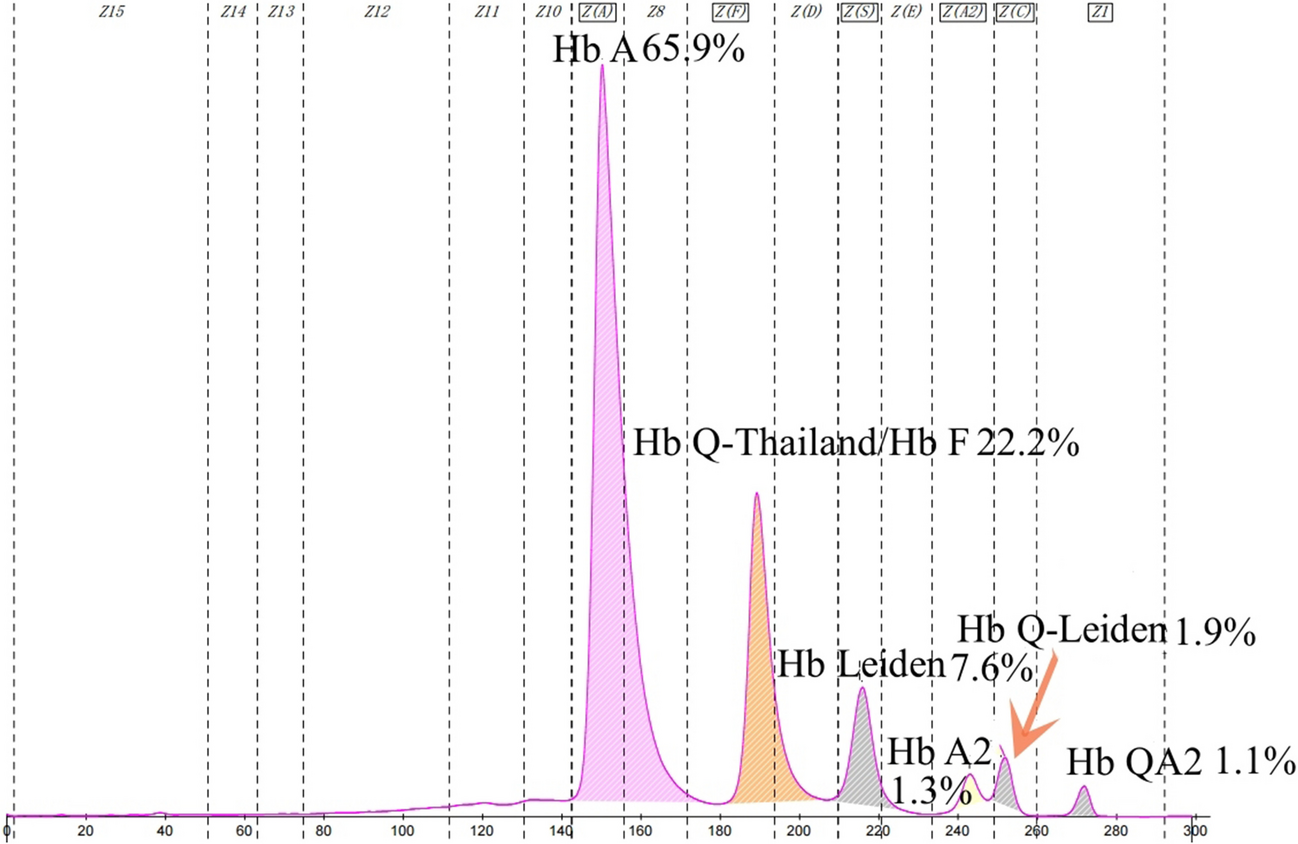 Asymptomatic Co-Inheritance of Hb Leiden (HBB:c.22_24delGAG), Hb Q-Thailand (HBA1:c.223G > C) and Deletional Alpha Thalassemia in a Young Chinese Male