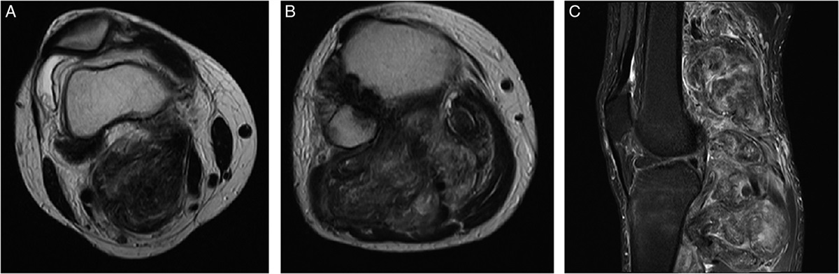 A Large Pigmented Villonodular Synovitis of the Proximal Tibiofibular Joint Mimicking Soft Tissue Sarcoma: A Case Report and Review of Literature