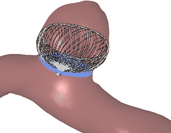 Assessment of intracranial aneurysm neck deformation after contour deployment