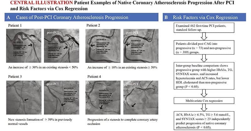 Identifying Risk Factors for Native Coronary Atherosclerosis Progression After Percutaneous Coronary Intervention