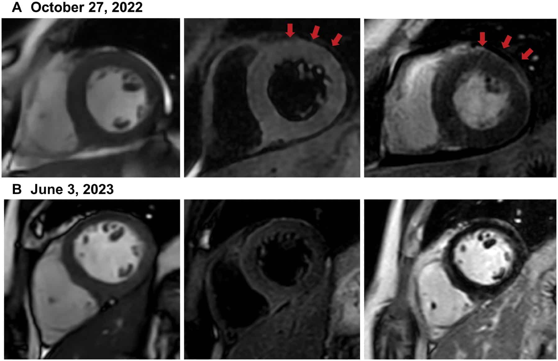 Case Report: Optical Pumped Magnetometer Magnetocardiography as a Potential Method of Therapy Monitoring in Fulminant Myocarditis