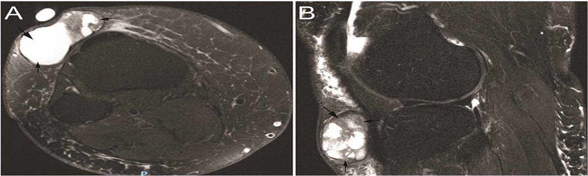 Recurring Hidradenocarcinoma of the Lower Extremity