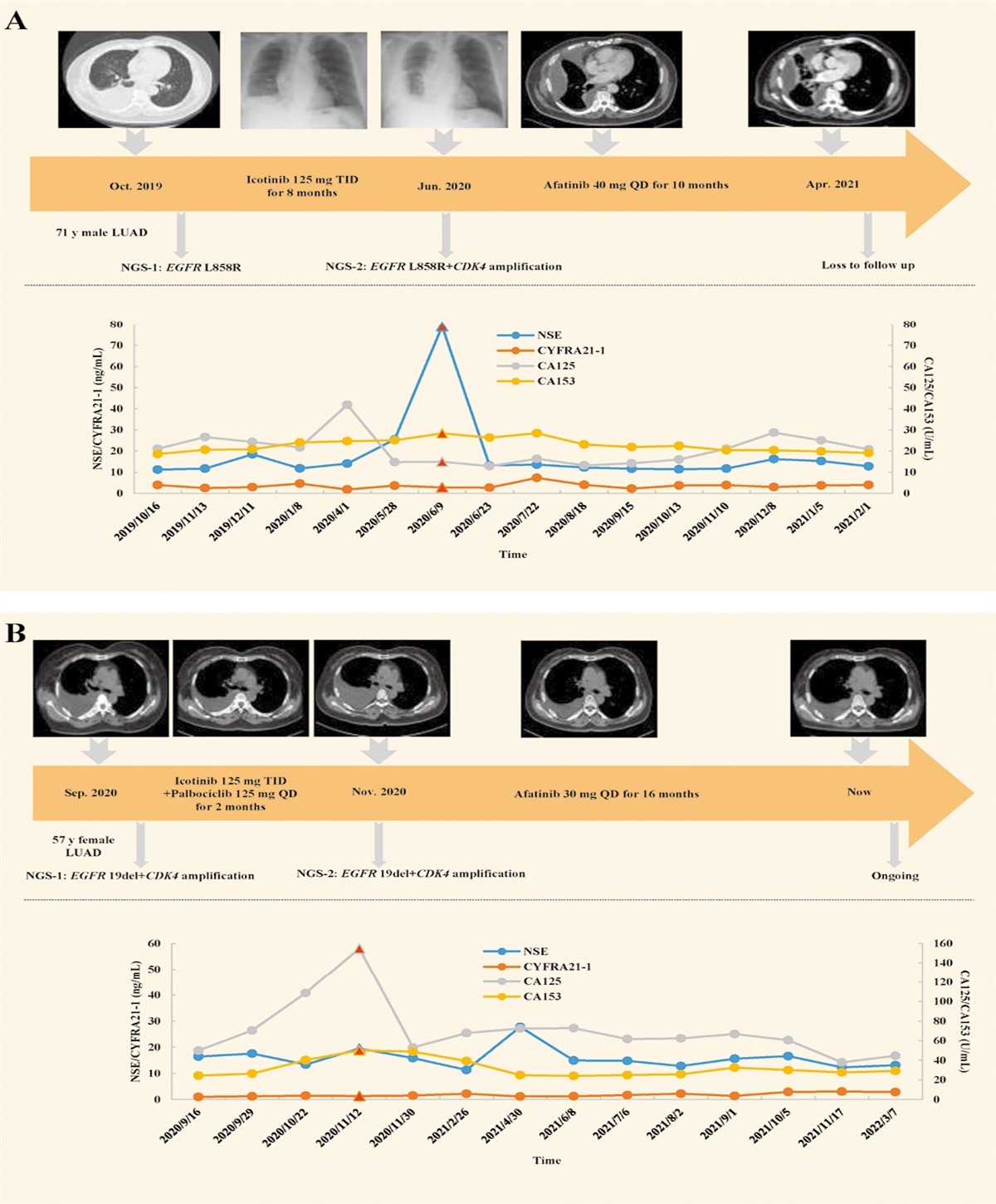 EGFR-mutant non-small cell lung cancer patients harboring CDK4 amplification show favorable response to afatinib: Two case reports