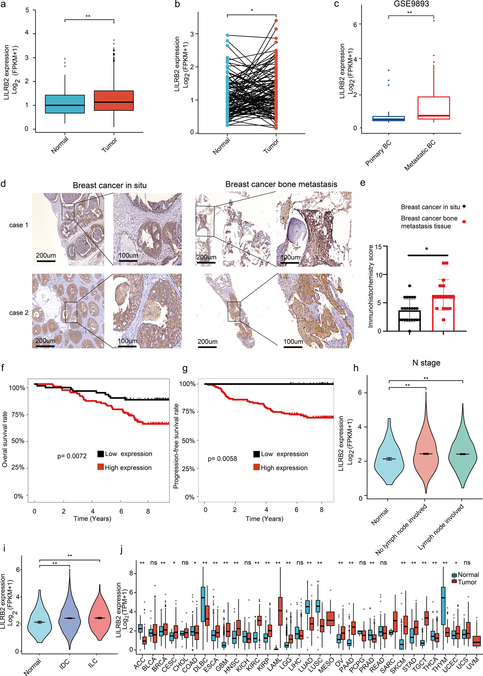 LILRB2 promotes immune escape in breast cancer cells via enhanced HLA-A degradation