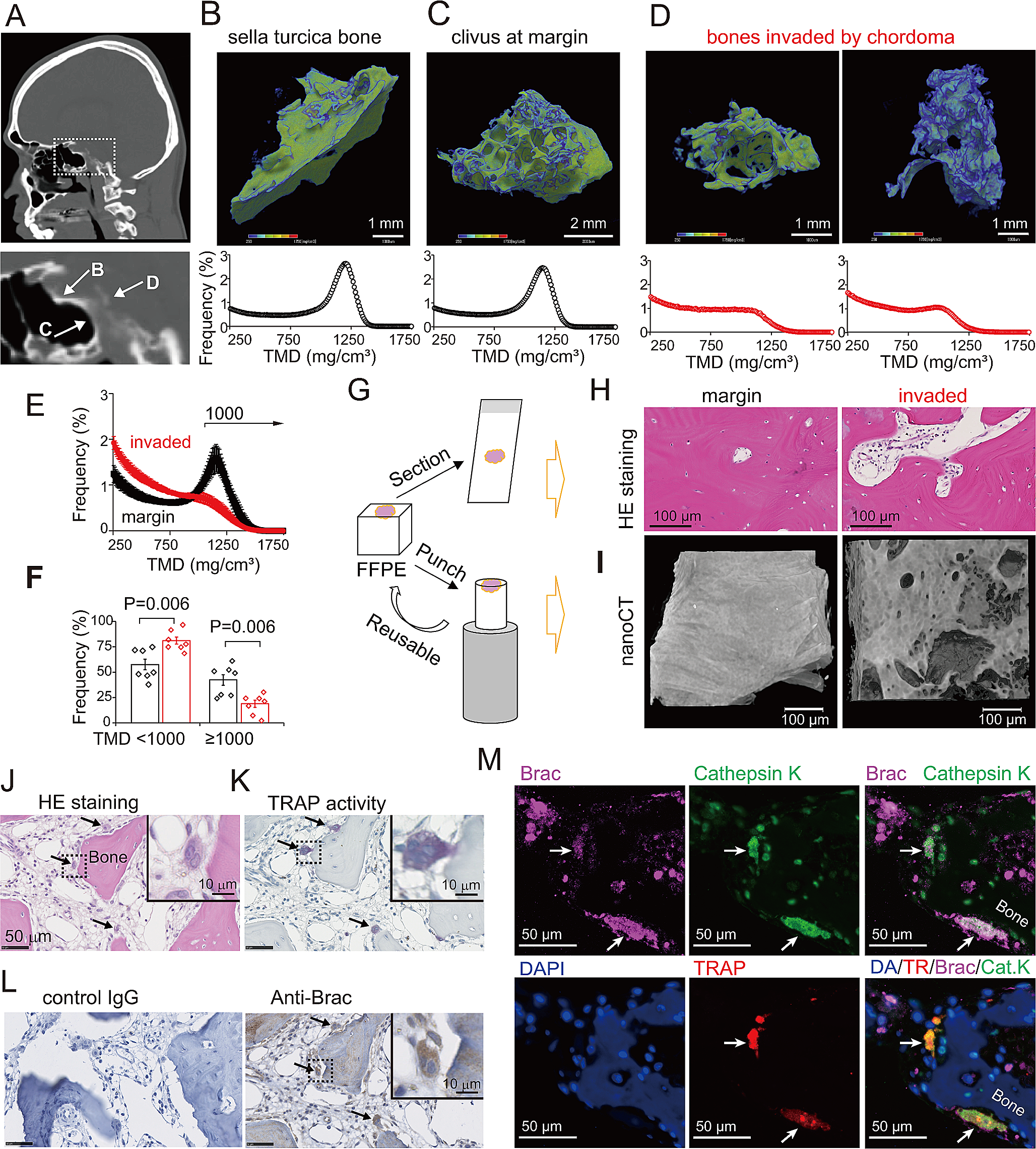 Chordoma cells possess bone-dissolving activity at the bone invasion front