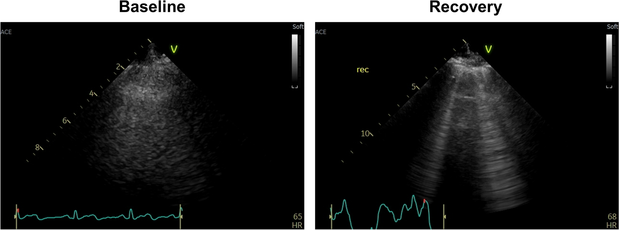 The roles of exercise stress echocardiography for the evaluation of heart failure with preserved ejection fraction in the heart failure pandemic era