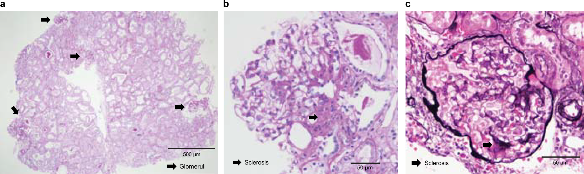 Familial focal segmental glomerulosclerosis with Alport-like glomerular basement changes caused by paired box protein 2 gene variant