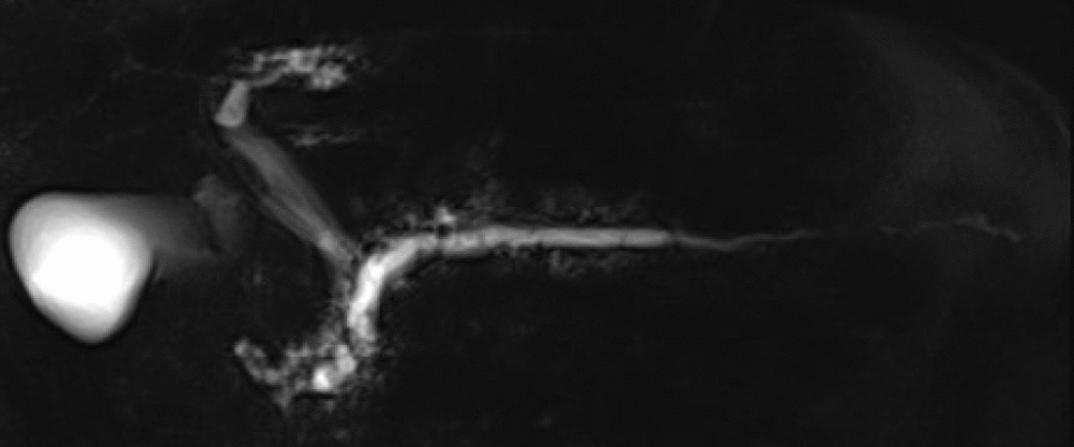 A rare case of acute obstructive suppurative pancreatic ductitis (AOSPD) which developed pyogenic spondylitis