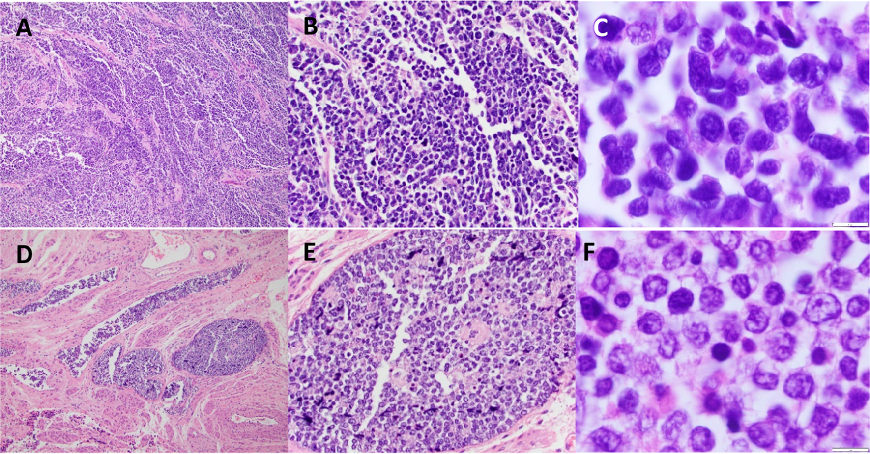 Transdifferentiation of diffuse large B-cell lymphoma to a poorly differentiated neoplasm following CAR T-cell therapy